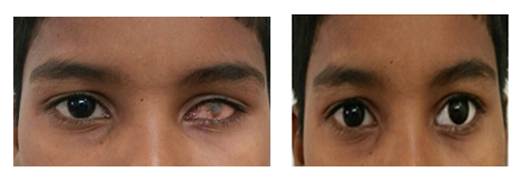 Custom Prosthesis