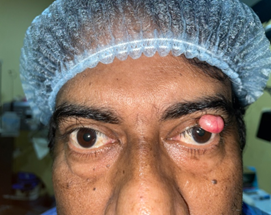 Malignant Tumour