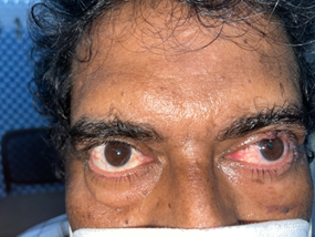 Malignant Tumour