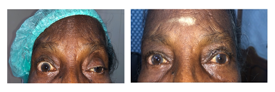 Ptosis