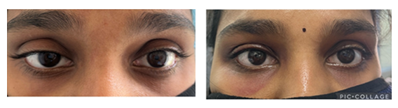 Ptosis
