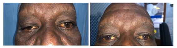 Ptosis