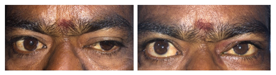 Ptosis