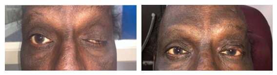Ptosis