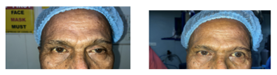 Ptosis