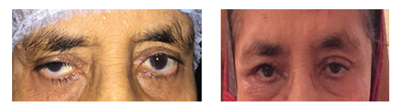 Ptosis