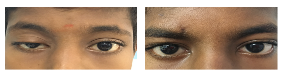Ptosis